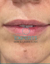before-image